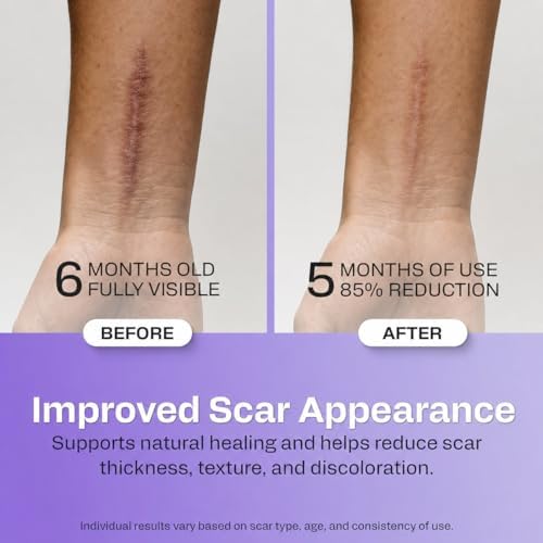 AWD Medical Silicone Scar Tape, Medical Grade, 1.6in x 120in Pre-Cut | Reusable Silicone Scar Sheets, Pre-Cut for C-Section, Surgery, Keloid & Acne; Latex-Free, Water-Resistant, FSA Eligible